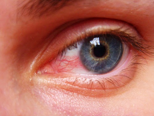 Eyes Problems Connected With Uveitis Disease